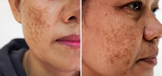 Pigmentation & Melasma Treatment